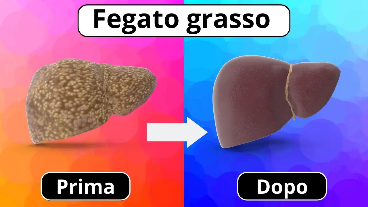 Steatosi epatica o fegato grasso, cosa mangiare? L’alimento che aiuta a ripulirlo