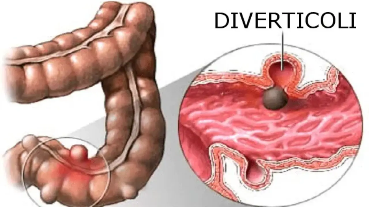 Diverticoli, quale dieta seguire per non infiammarli? I cibi sì e i cibi no